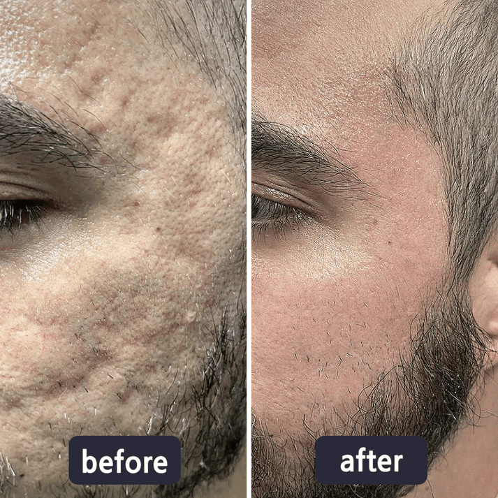 🔥Limited-time 60% sale--Scar Repair Cream — Smooth, Clear, Confident Skin