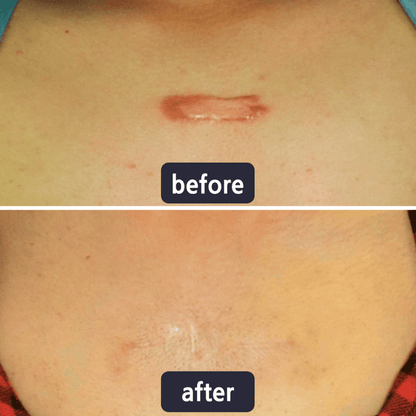 🔥Limited-time 60% sale--Scar Repair Cream — Smooth, Clear, Confident Skin